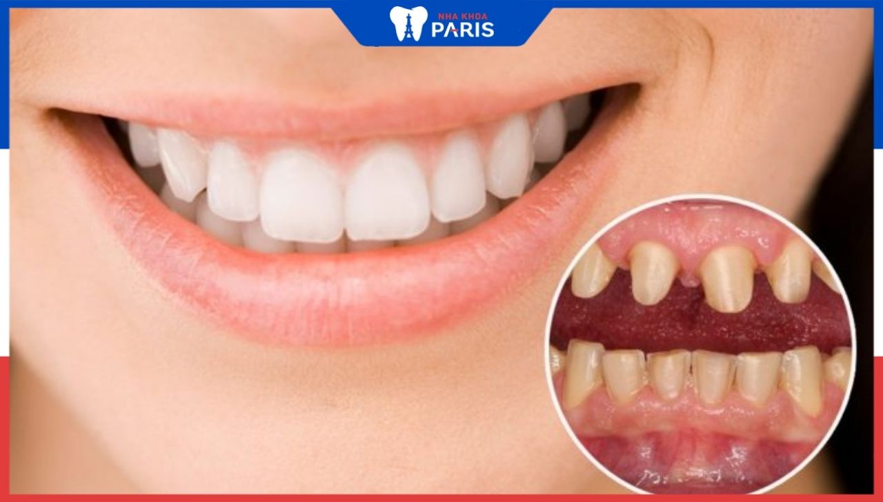 Bọc răng sứ thẩm mỹ – Sự lựa chọn hoàn hảo cho nụ cười đẹp